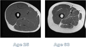 Cross section of thigh muscle, notice what happens to muscle/fat ratio over the years? Plan of attack must change with age. Preserving/building muscle is essential.